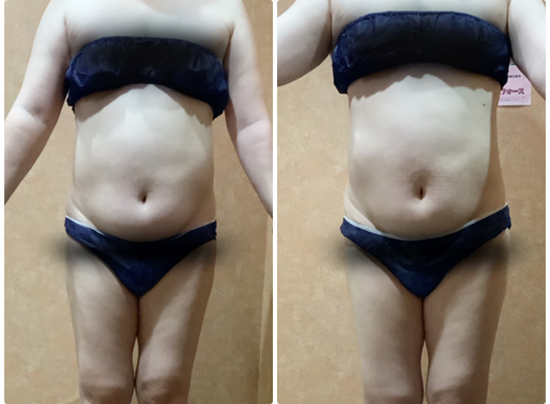 脂肪冷却でご自身の変化にやる気もアップ