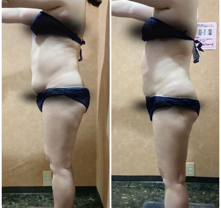 脂肪冷却でご自身の変化にやる気もアップ