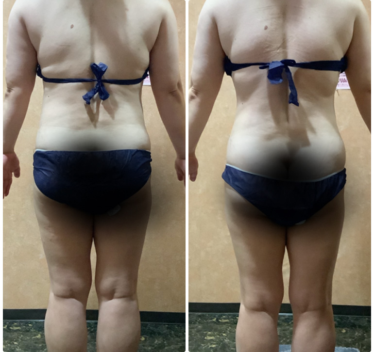 脂肪冷却でご自身の変化にやる気もアップ